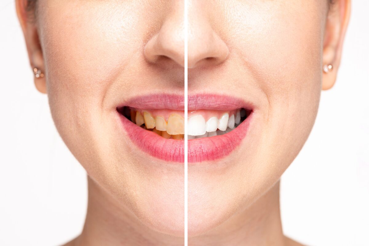 Teeth Whitening Treatments: The Complete Guide to a Brighter Smile